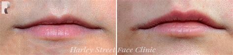 Lip Filler Swelling Stages What You Need To Know The Harley Street