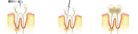 Endodontie Wurzelkanalbehandlung Zahnarztpraxis Dr Barbara Richter