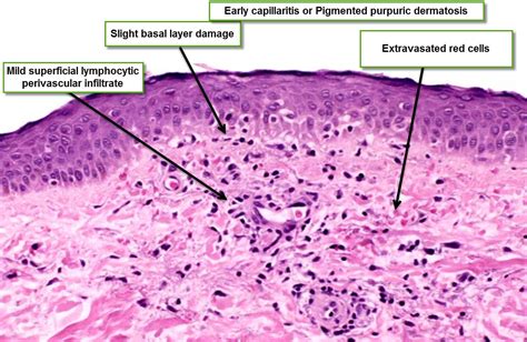 Superficial Perivascular Dermatitis