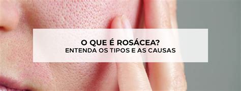 O QUE É ROSÁCEA ENTENDA OS TIPOS E AS CAUSAS Blog Ada Tina