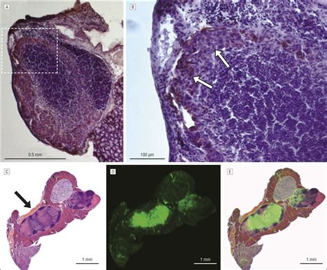 Metastatic Squamous Cell Carcinoma Lymph Node