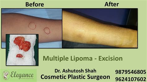 Lipoma Treatment In Vapi Surat