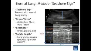 Basic Lung Ultrasound How To Perform A Lung Exam And Evaluate For