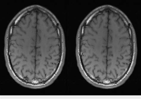 Brain Magnetic Resonance Imaging Mri Follow Up At Four Months Brain