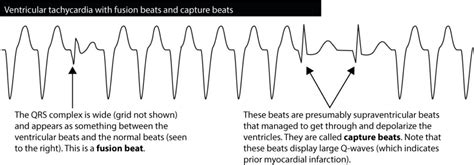 Ventricular tachycardia (VT): ECG criteria, causes, classification ...