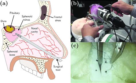 A Endoscopic Endonasal Surgery B Dura Suturing In Endonasal