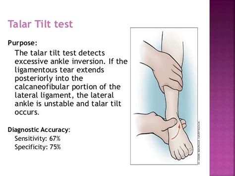 Sprained Ankle