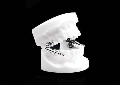 Herbst Telescopic Universal Orthodontic Lab