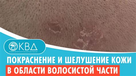 Покраснение и шелушение кожи в области волосистой части головы (№ 606 ...