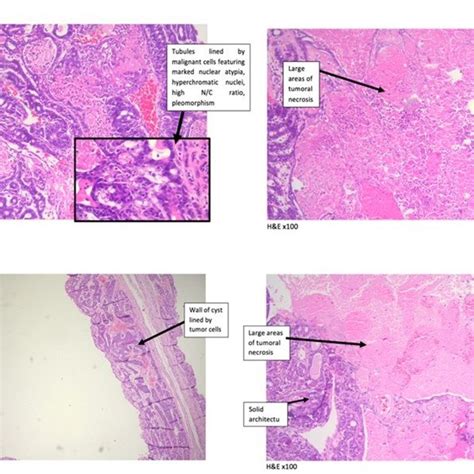 Histological Analysis Of Mammary Tumors Induced By Dmba Isolated At