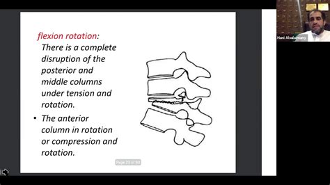 Thoracolumbar Fractures Case Discussion Youtube