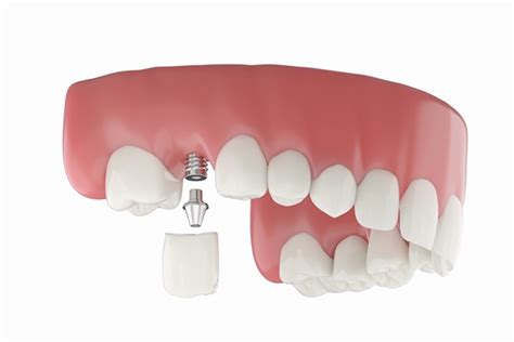 Implant Dentistry The Single Tooth Replacement Process Stunning