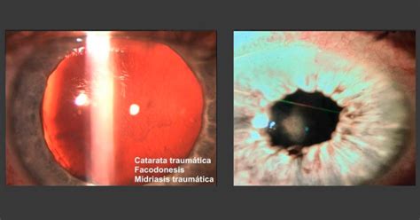 T Cnicas En Pupiloplastia E Iridoplastia Facoelche