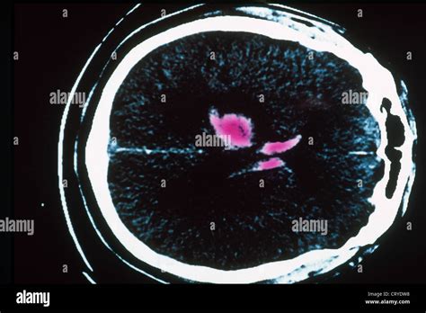 Hematoma Brain Scan Stock Photo Alamy