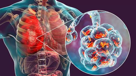 Cases Of White Lung Syndrome Rising Globally What It Is Symptoms And Preventive Measures You