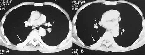 Unusual Cause Of Mediastinal Mass Bmj Case Reports