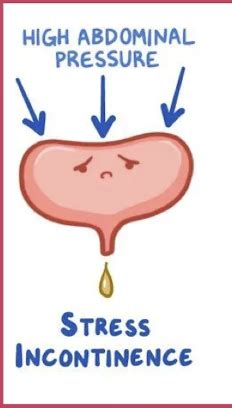 Bladder Dysfunctions Pelvic Organ Prolapse And Diastasis Rectus