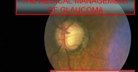 Glaucoma Specialist Blog The Glog