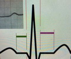 Parts Of Ekg Wave Flashcards Quizlet