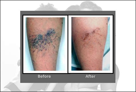 Laser Vein Removal Treatments For Spider Veins Hartford Ct