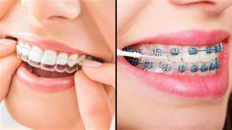 Invisalign and braces | Dentagama