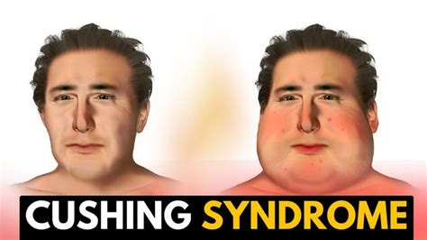 What Are Three Or Four Symptoms Of Cushing Syndrome What Are Three Symptoms Of Cushings