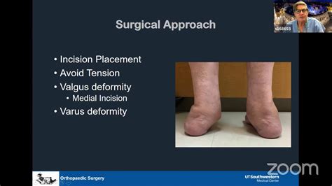 Surgical Treatment Of Ankle And Hindfoot Charcot Neuroarthropathy Youtube