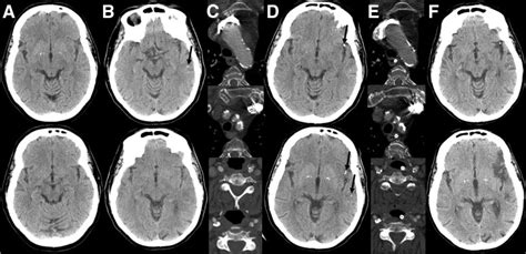 Early Relapsing Calcified Cerebral Embolism Journal Of Stroke And