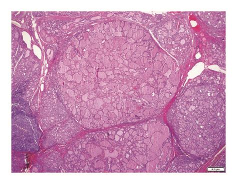 Multinodular Goiter Hande 20x Download Scientific Diagram