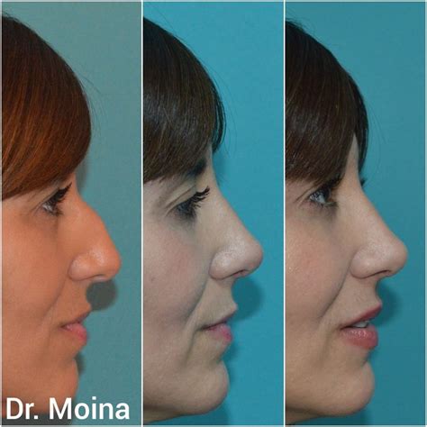 Pin By Rinoplastia Dr Moina On Rinoplastia Antes Y Después Rhinoplasty Nose Jobs Nose Job