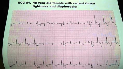 Ekg Uri M Ben Zur Md Facc Cardiovascular Electrocardiogram Youtube