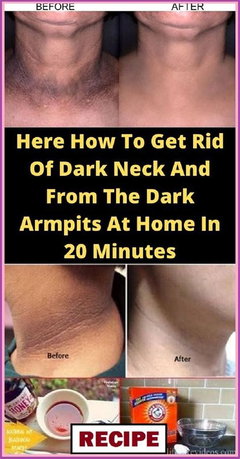 How To Get Rid Of Dark Armpits Artofit