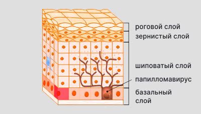 Роговая кератома (кожный рог) - что это, что делать, нужно ли удалять