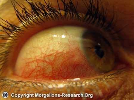 Morgellons Symptoms Of Biofilm Infection Symptoms Autoimmune Disease