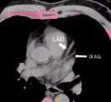 Coronary Artery Calcification on CT Scanning: Practice Essentials, Coronary Artery Calcium ...