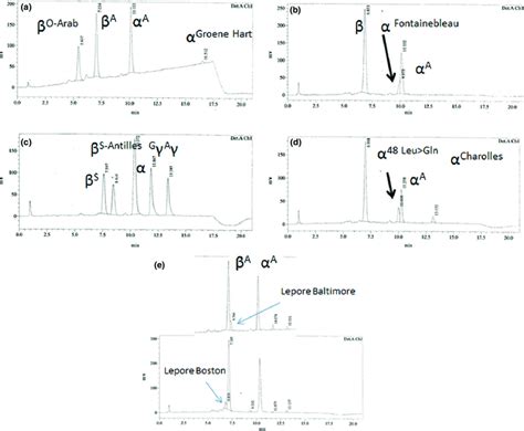 Rp Hplc Elution Profiles Of Globin Chain Observed In Carriers Of Rare