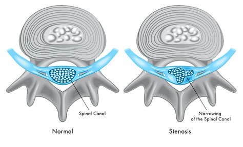 Foraminal Stenosis Minnesota Spine Institute