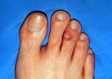 Myxoid Cysts Is Skin Disease It Usually Happens On The Fingers Or Toes