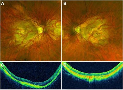 Postoperative Optos photography demonstrating tilted discs,... | Download Scientific Diagram