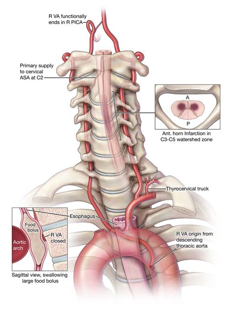 Anterior Spinal Artery Infarction Due To Compression Of An Anomalous