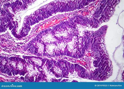 Colon Adenocarcinoma Light Micrograph Stock Image Image Of Science