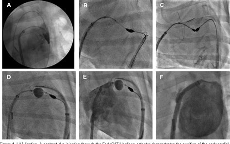 Figure 1 From Catheter Based Left Atrial Appendage Laa Ligation For