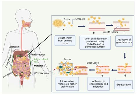 Cancers Free Full Text Immunotherapy For Peritoneal Carcinomatosis