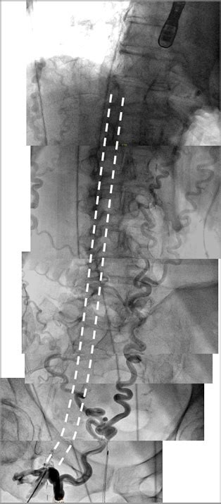 First In Man MitraClip Via Pulmonary Vein Access Through A Right Mini