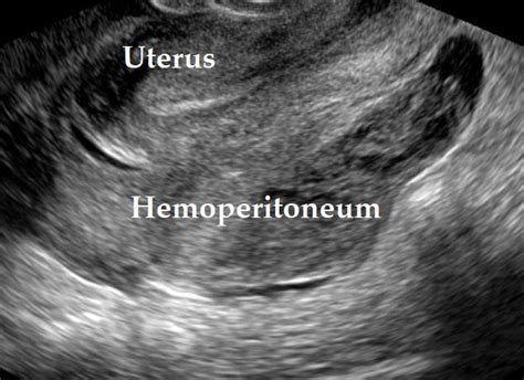 Hemoperitoneum Gynaecologia