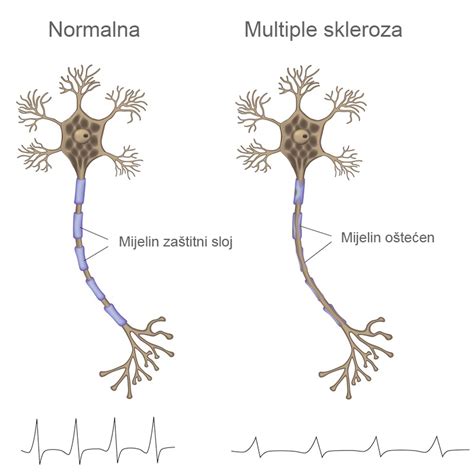 Multipla Skleroza Definicija Ms A Hendi Portal