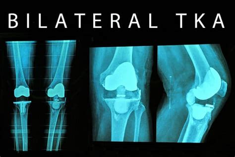 Bilateral Knee Replacement Surgery - X10 Therapy