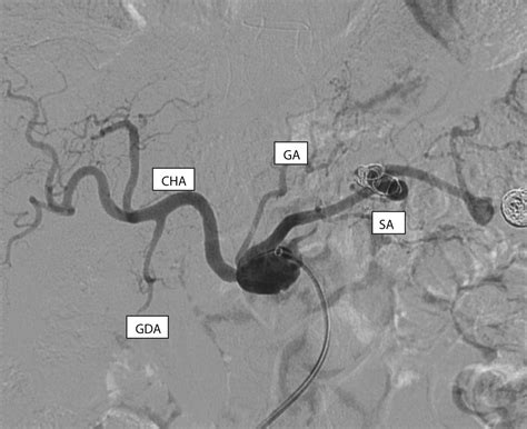 Endovascular Repair Of Concomitant Celiac And Splenic Artery Aneurysms Using A Combination Of