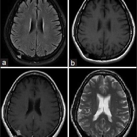 Initial MRI Brain Axial Cuts A T2 Flair B T1 Weighted C