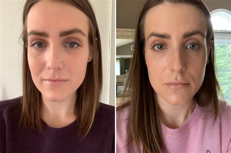 Lip Injections Before And After Juvederm